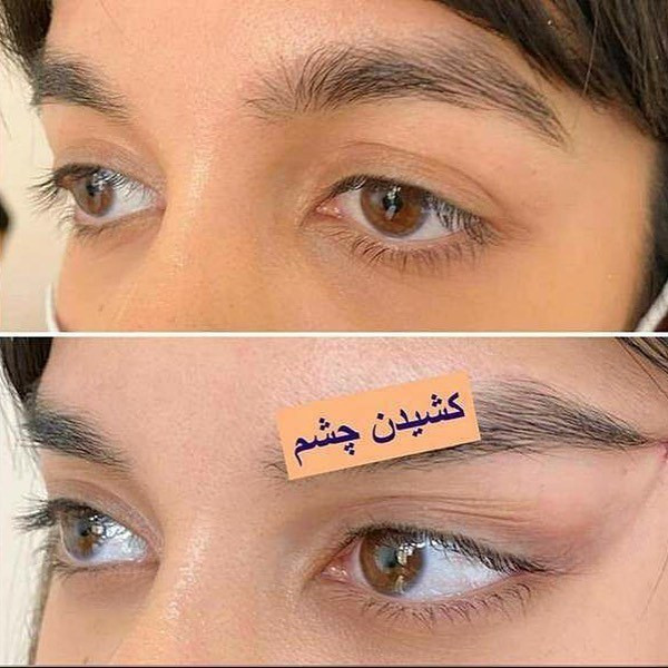 کش لیفت چشم وفیس لیفت ابرو(قیمت مناسب،عرضه مستقیم)