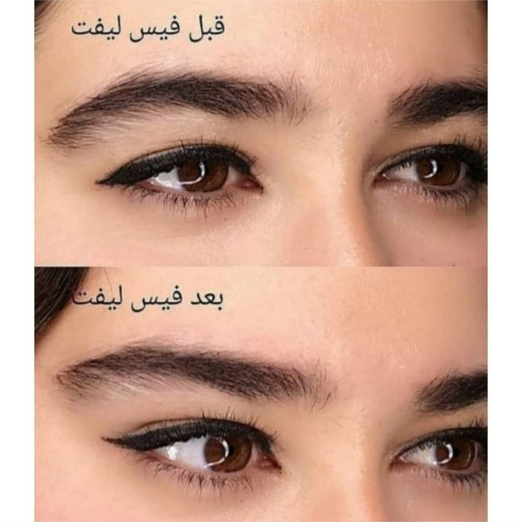 کش لیفت چشم وفیس لیفت ابرو(قیمت مناسب،عرضه مستقیم)