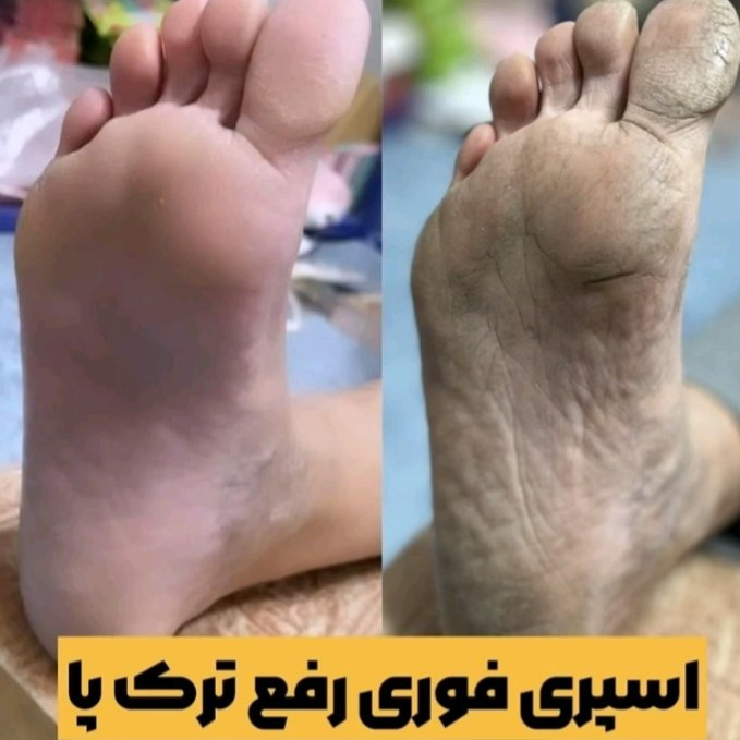 اسپری ترک پا راکو مدل ویتامینE(قیمت مناسب،عرضه مستقیم)
