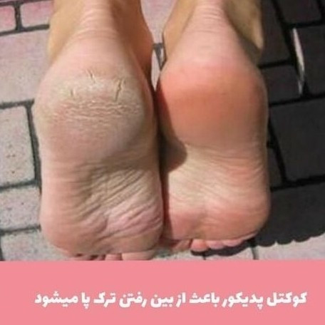 کوکتل پا ازبین برنده ترک پا(قیمت مناسب،عرضه مستقیم)